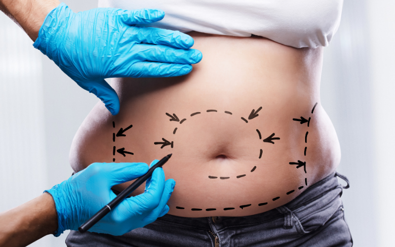 liposuction nedir